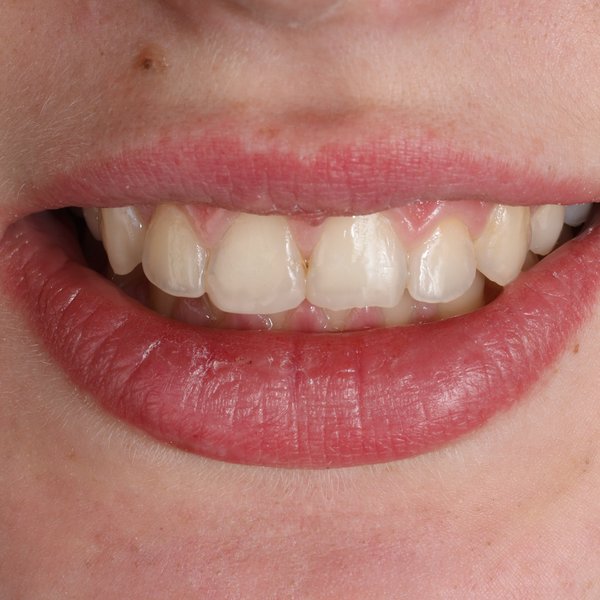 Коронка цирконієва повна анатомія